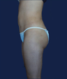 liposuction