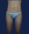 liposuction