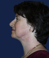 liposuction