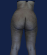 liposuction