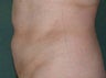 Lipo to Tummy