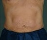 Liposuction