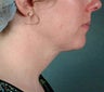 Lipo to Underchin
