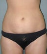 Liposuction