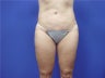 Liposuction