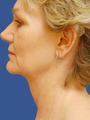 Jawline / Neck Lipo