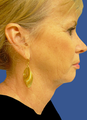 Jawline / Neck Lipo