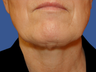 Jawline / Neck Lipo
