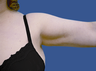 Liposuction Upper Arm