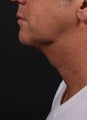 Neck Liposuction