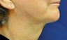 Neck Liposuction