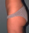 Liposuction