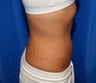 Liposuction