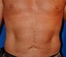 Liposuction
