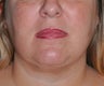 Neck Liposuction