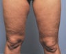 Knee Liposuction
