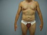 Liposuction