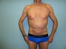 Liposuction