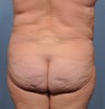 Flank Liposuction