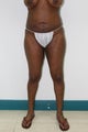 Liposuction and Fat Injection
