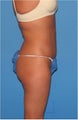 Liposuction