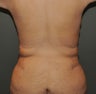 Liposuction