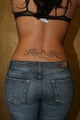 Back Liposuction
