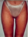 Liposuction