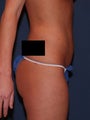 Liposuction