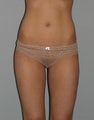 Liposuction