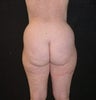 Liposuction