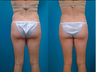 Liposuction