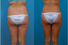 Liposuction