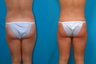 Liposuction