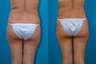 Liposuction