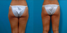 Liposuction