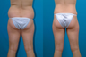 Liposuction
