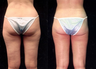 Liposuction