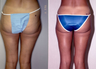 Liposuction
