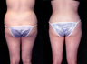 Liposuction