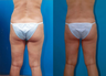 Liposuction