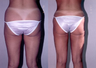 Liposuction