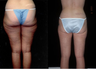 Liposuction