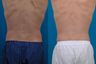 Liposuction