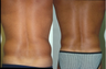 Liposuction