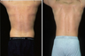 Liposuction