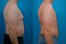 Liposuction