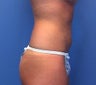 Liposuction