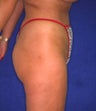 Liposuction