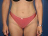 Liposuction